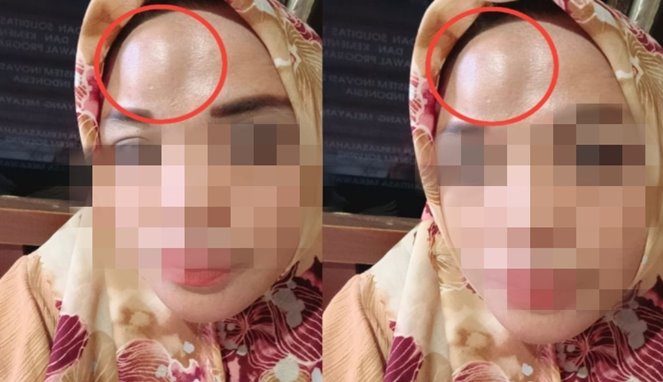 Korban Penganiayaan seorang Wanita di Bulukumba Korban Penganiayaan seorang Wanita di Bulukumba