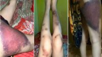 Tangkapan layar kondisi kaki korban Selvy yang mengalami lebam serius diduga akibat penganiayaan suaminya. (Foto kolase) IRT Hamil Lima Bulan di Bulukumba Mengaku Dianiaya Suami, Foto Lebam Gegerkan Warganet
