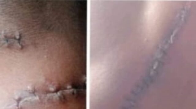 Dibacok Enam Orang hingga Nyaris Tewas, Kasus Mono Dg Tola 'Mandek' Baru Satu Tersangka