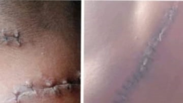 Luka yang kena benda Tajam, Leher dan Pinggul Dibacok Enam Orang hingga Nyaris Tewas, Kasus Mono Dg Tola 'Mandek' Baru Satu Tersangka